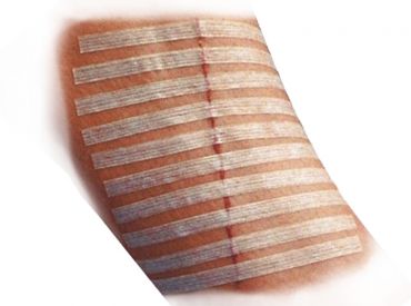 3M Steri-Strip Wundverschlussstreifen für atraumatische Wundversorgung